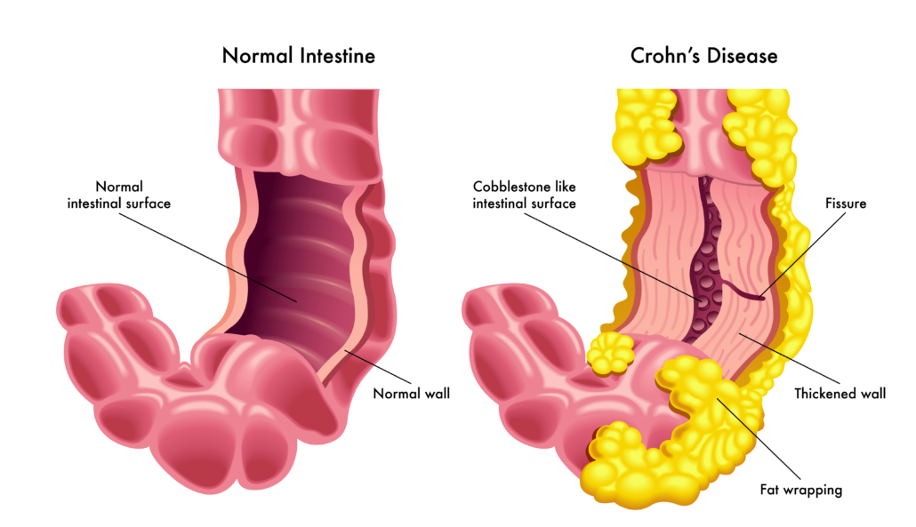 Illustrasjon av tarm med og uten betennelse med Crohns