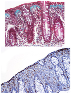 Mikroskopbilde av to varianter av mikroskopisk kolitt
