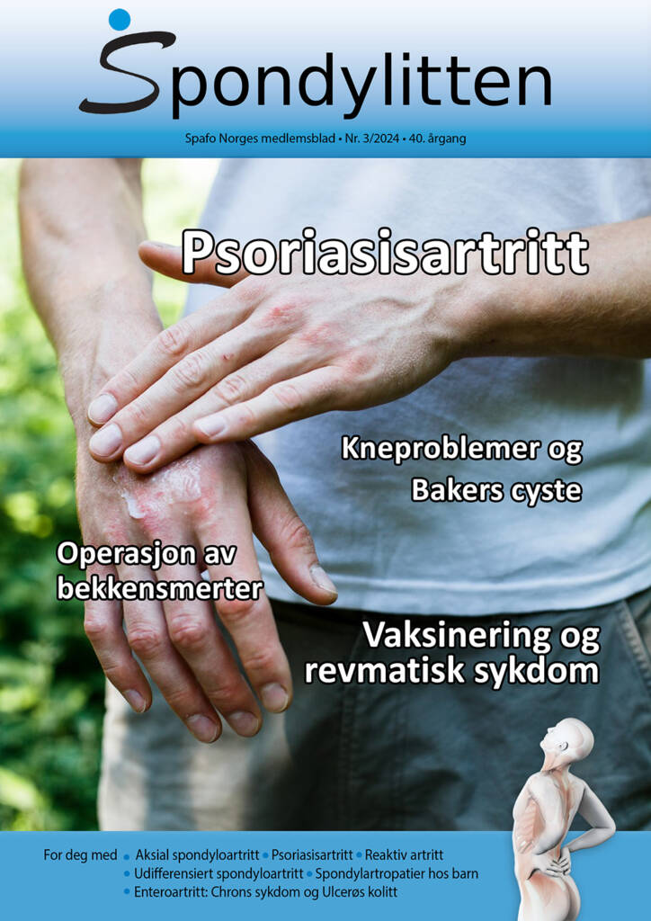 Forsiden til Spondylitten 3-24 med temaer som psoriasisartritt, Bakers cyste, operasjon av langvarige bekkensmerter og vaksine ved revmatisk sykdom