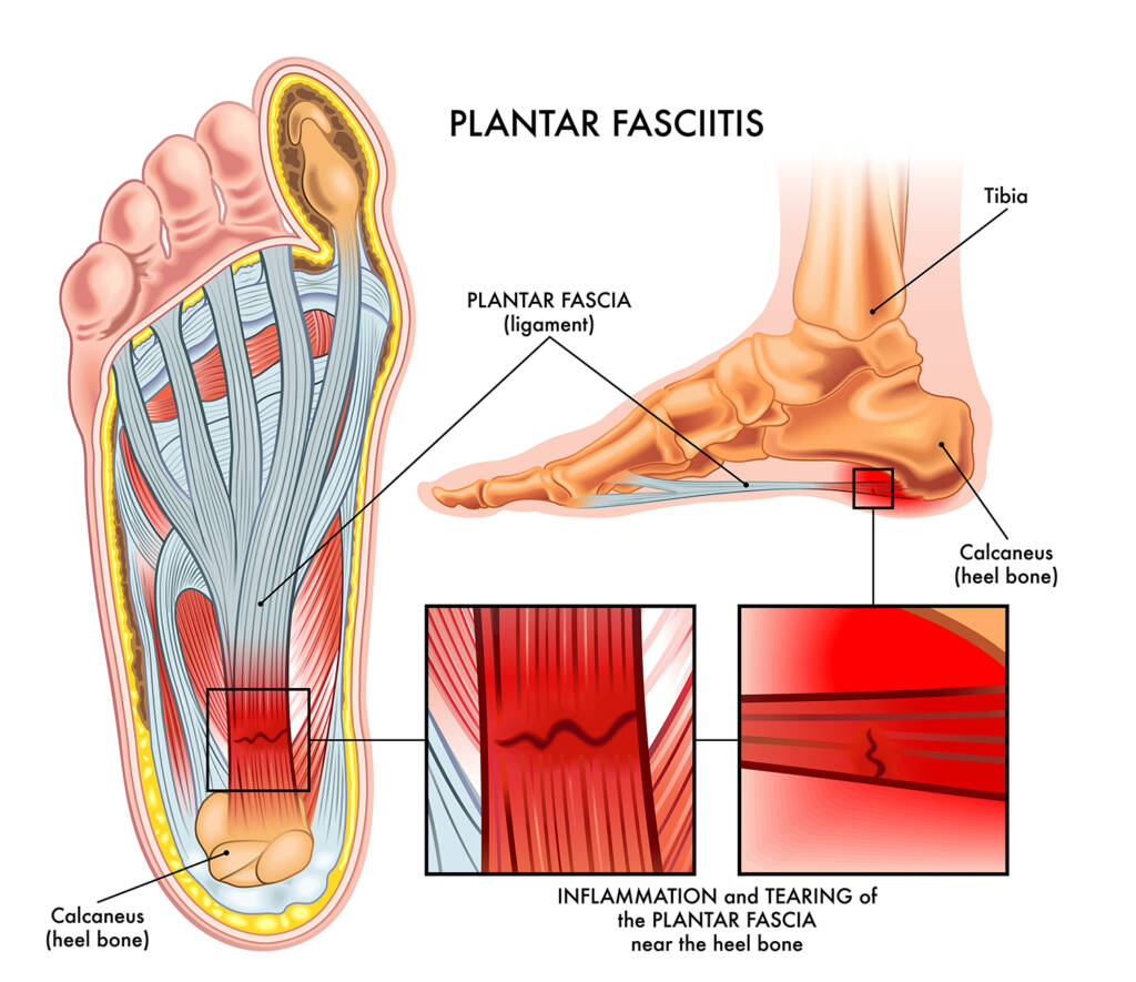 Plantar Fasciitt - illustrasjon