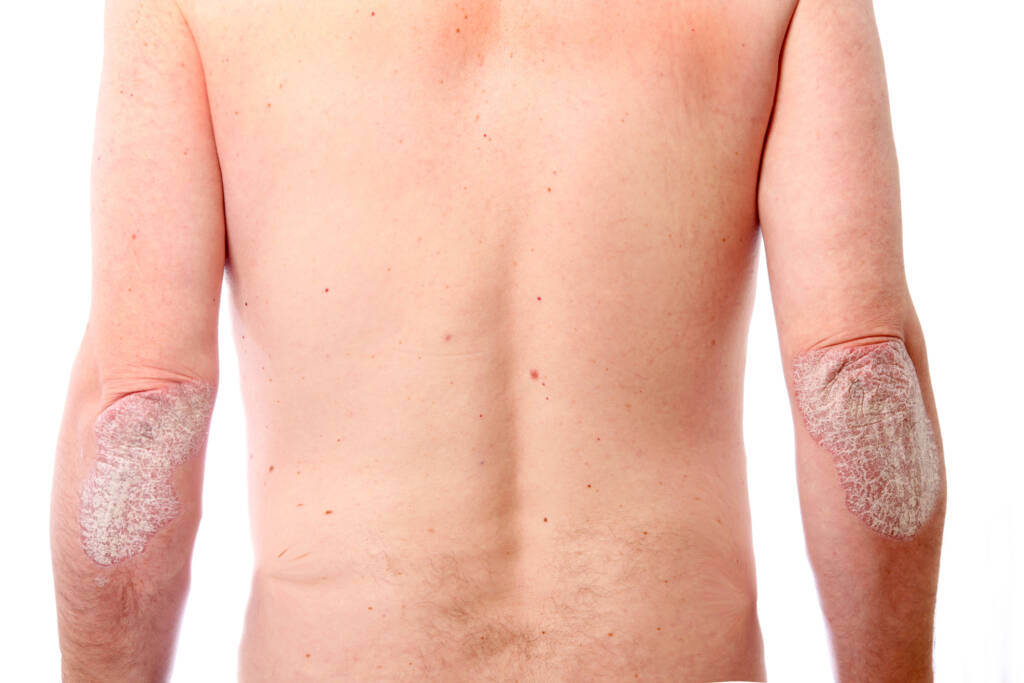 Mann sett bakfra med psoriasis på begge albuer