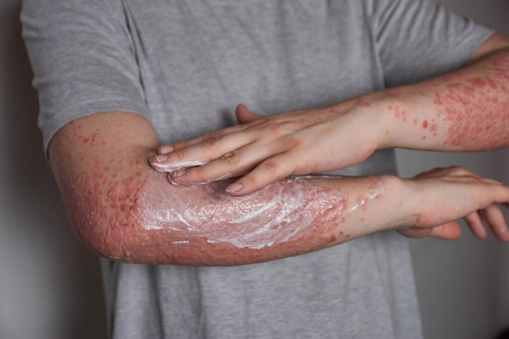 Mann med masse psoriasis på armer smører fuktighetskrem på den ene
