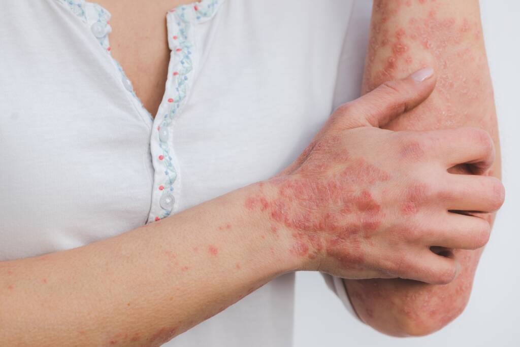 Kvinnehånd med psoriasis holder på albue med psoriasis