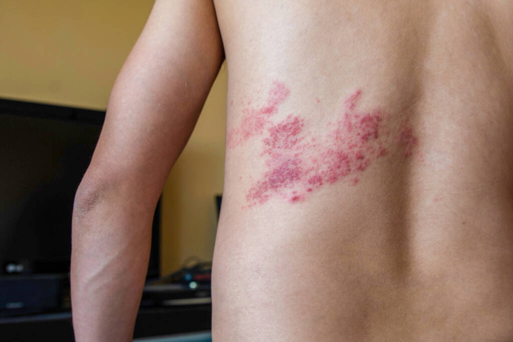 Helvetesild - herpes zoster på ryggen til en mann